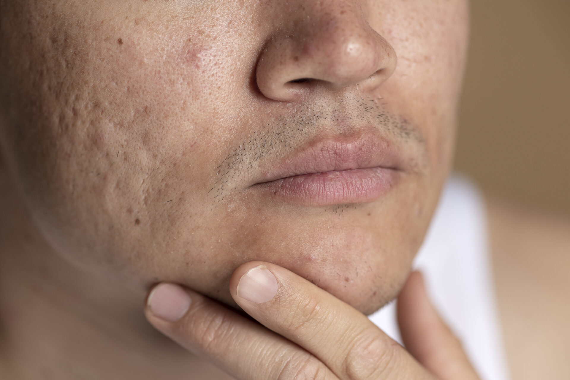 How to Remove Acne Scars Naturally in a Week