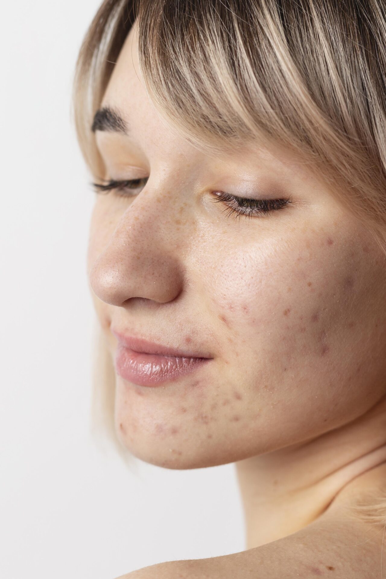 How to Get Rid of Acne Overnight