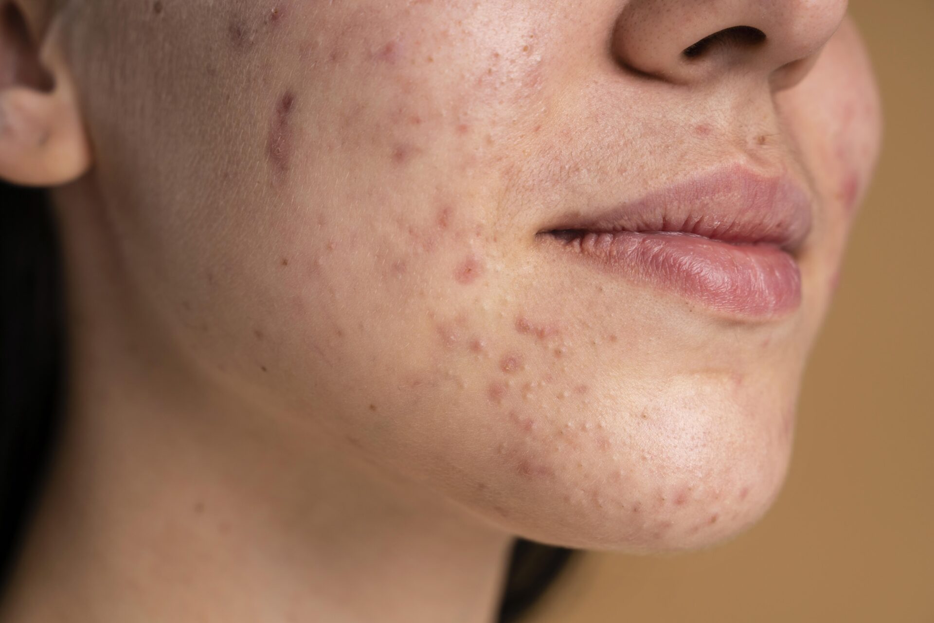 How to Remove Acne Scars Naturally in a Week